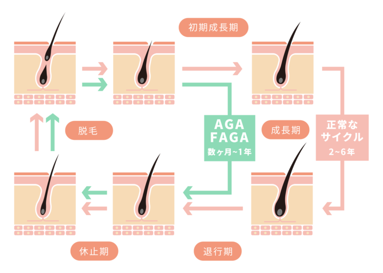 AGA・FAGAの原因