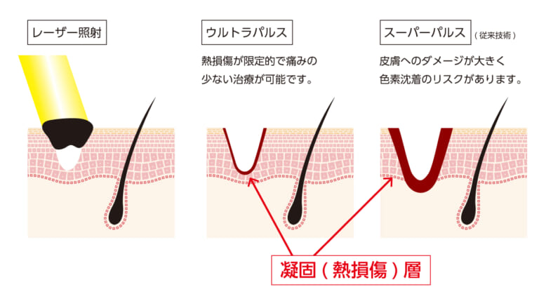 炭酸ガスレーザー（ほくろ・いぼ除去）とは？