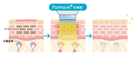 フォーマアルファIPLの特長