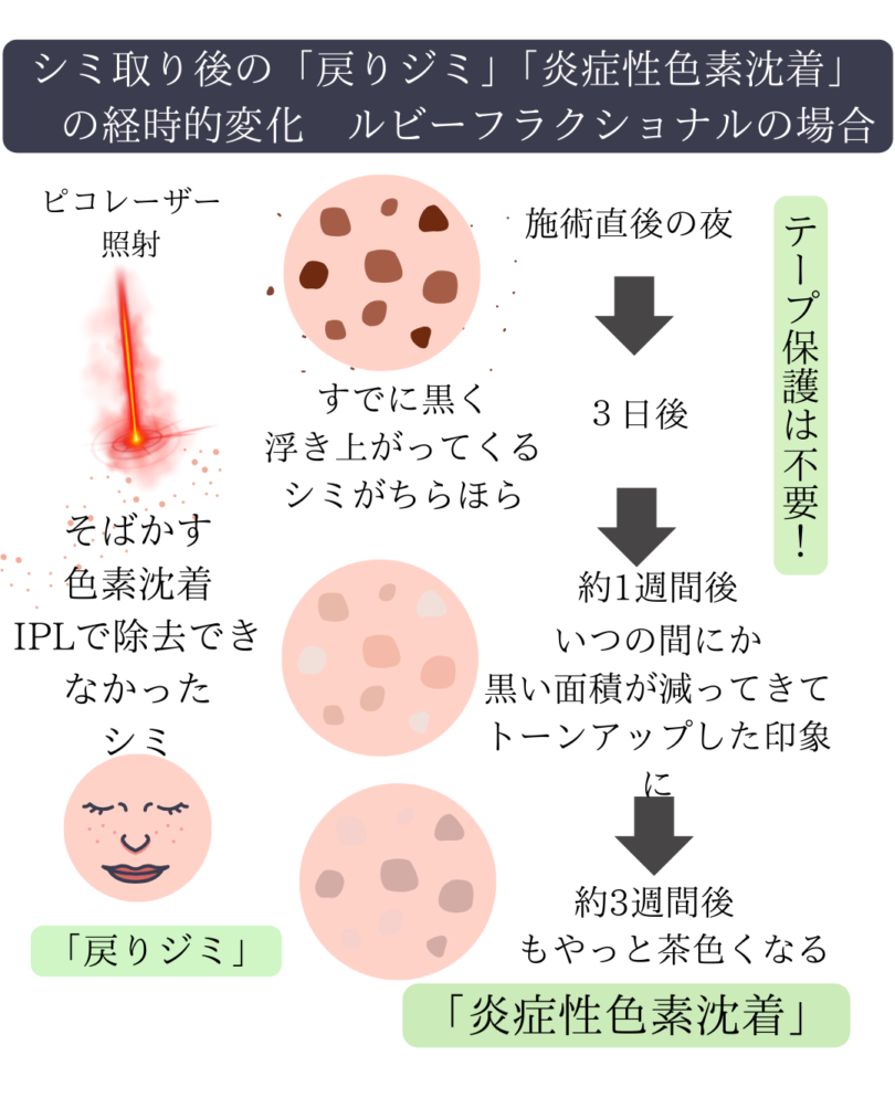 ディスカバリーピコレーザーの詳しい内容
