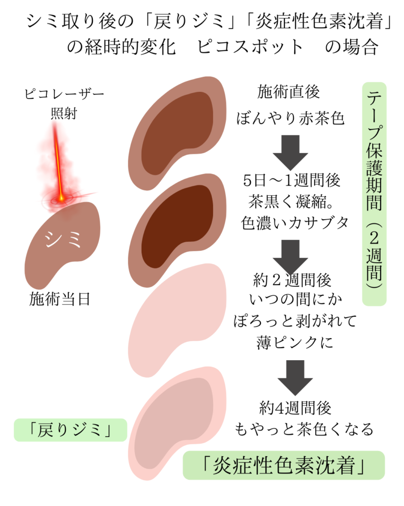 ディスカバリーピコレーザー施術中のスキンケア