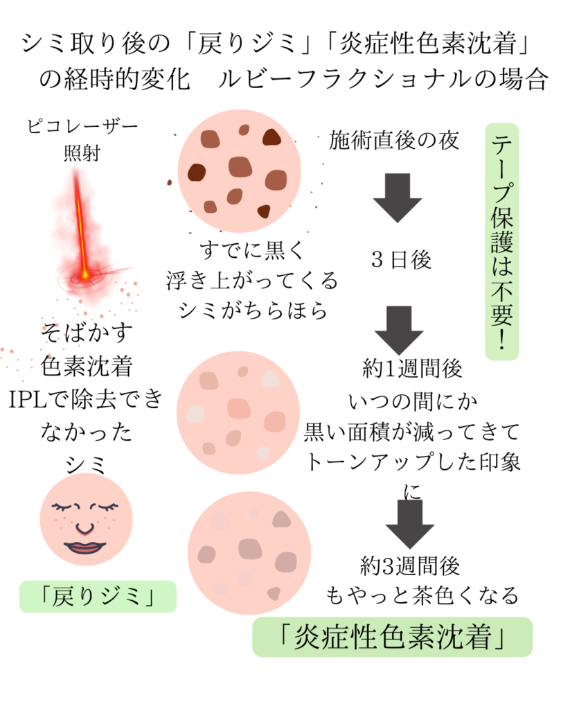 ディスカバリーピコレーザー施術中のスキンケア